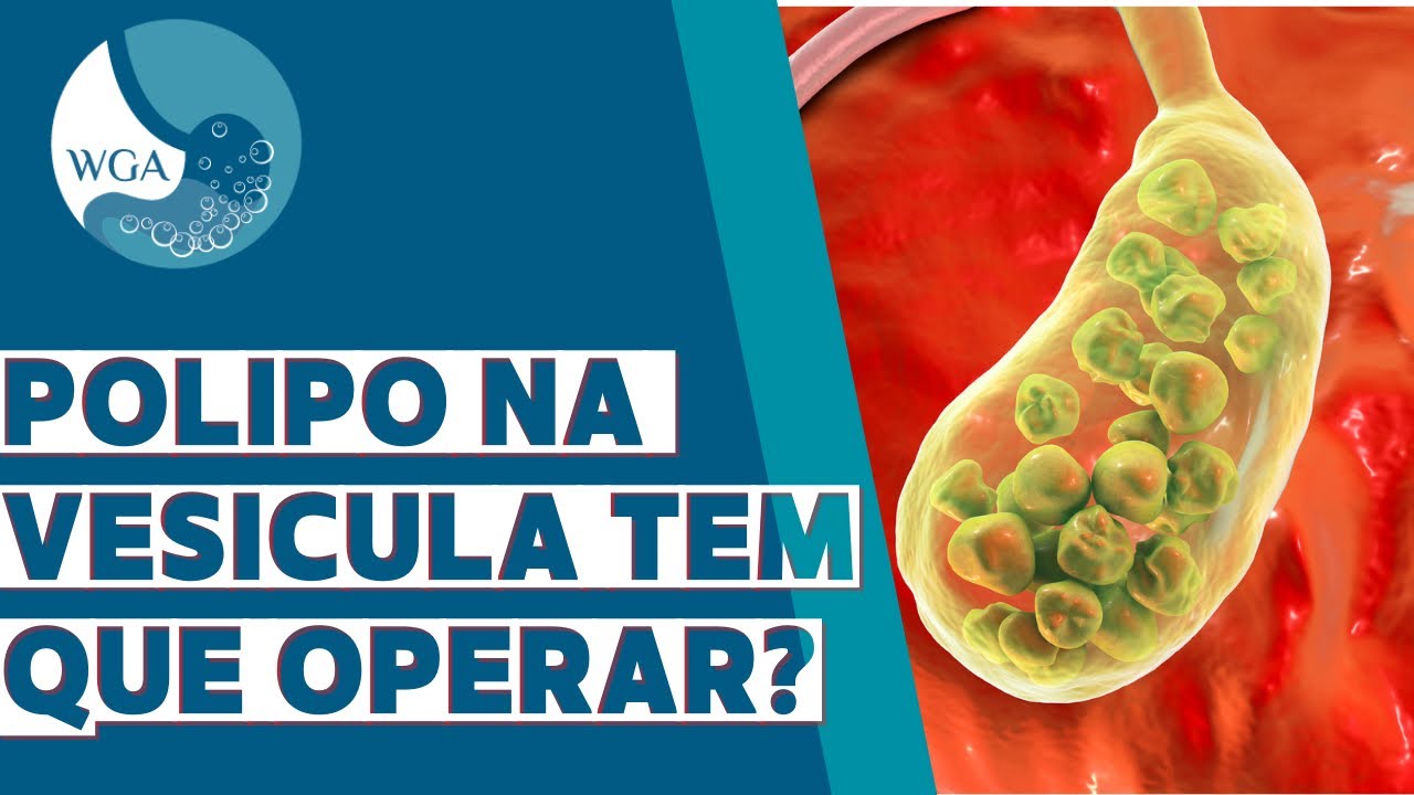 Precisa operar pólipo na vesícula?