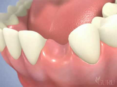 comment renforcer un pilier