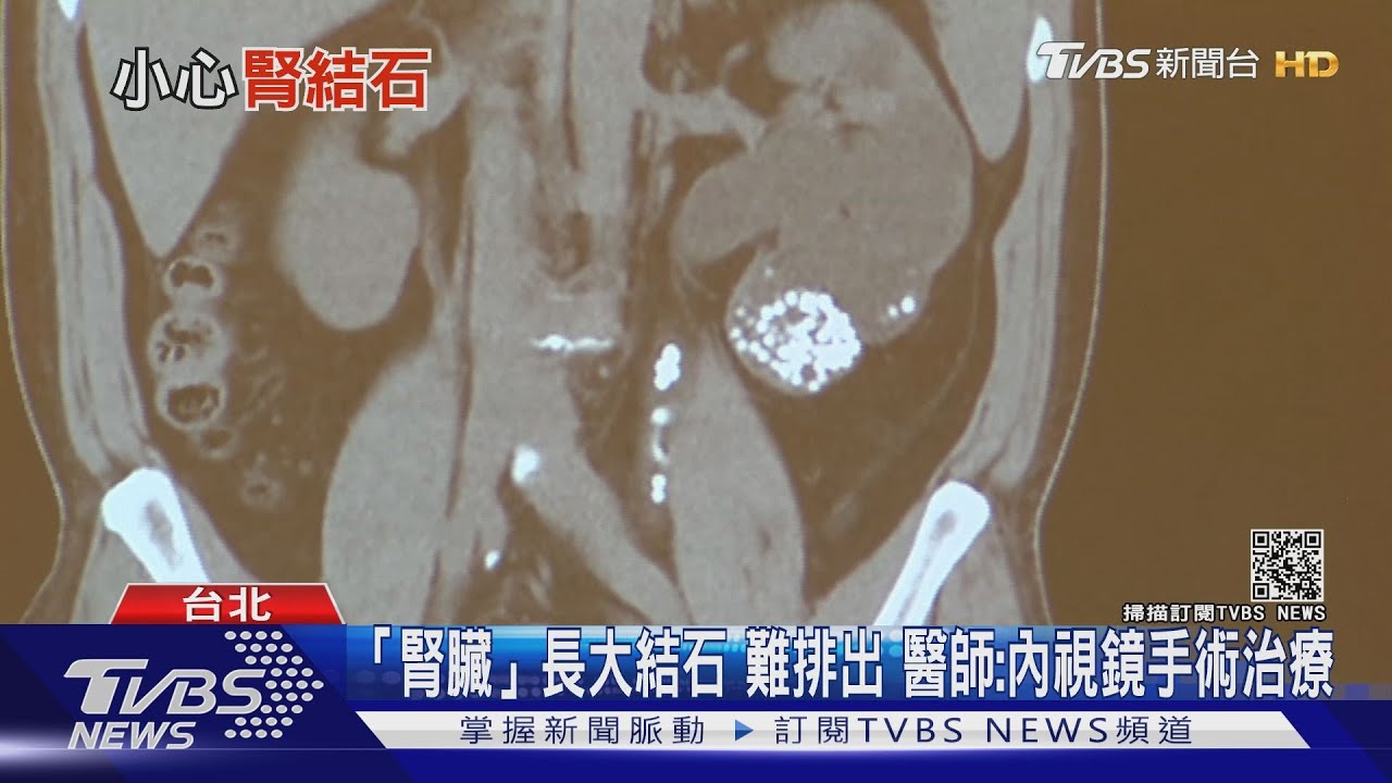 「這部位」劇烈疼痛 檢查發現「腎兩側」長出驚人結石!