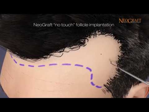 NeoGraft Hair Transplant System Explained Follicular...