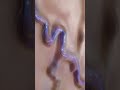 Varicose Vein Treatment