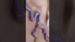 Download lagu Varicose Vein Treatment mp3