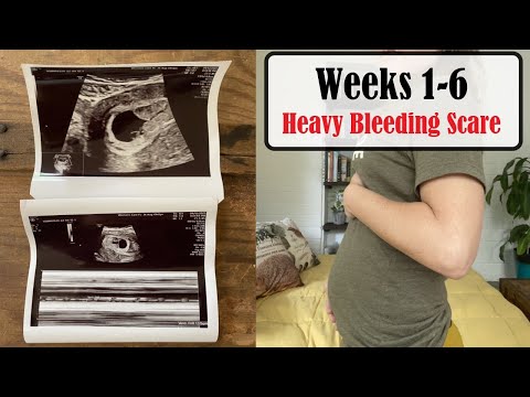I'm PREGNANT! // Scary 1st Trimester Bleeding - SUBCHORIONIC HEMATOMA
