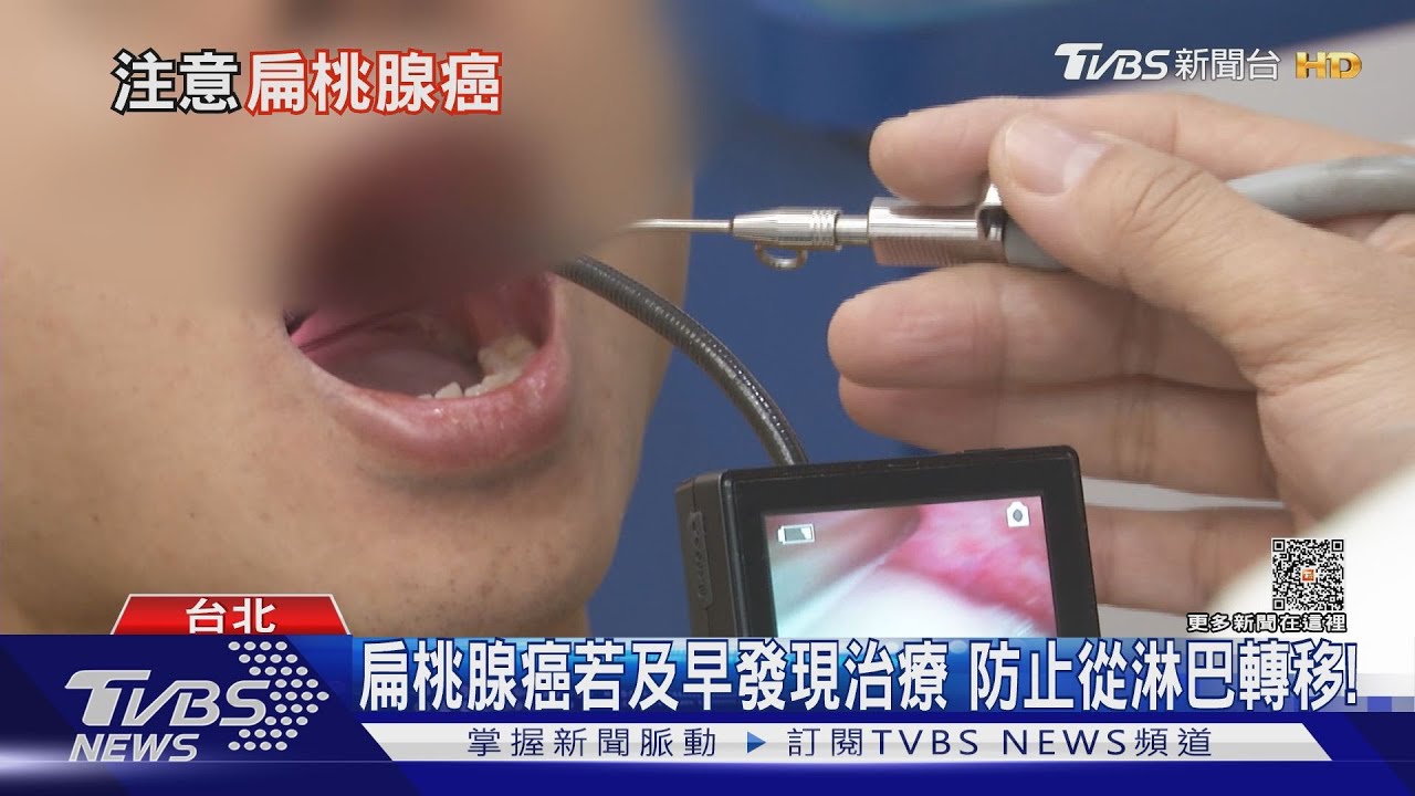 喉嚨出現「這幾種」症狀... 醫師:罹扁桃腺癌機率高!