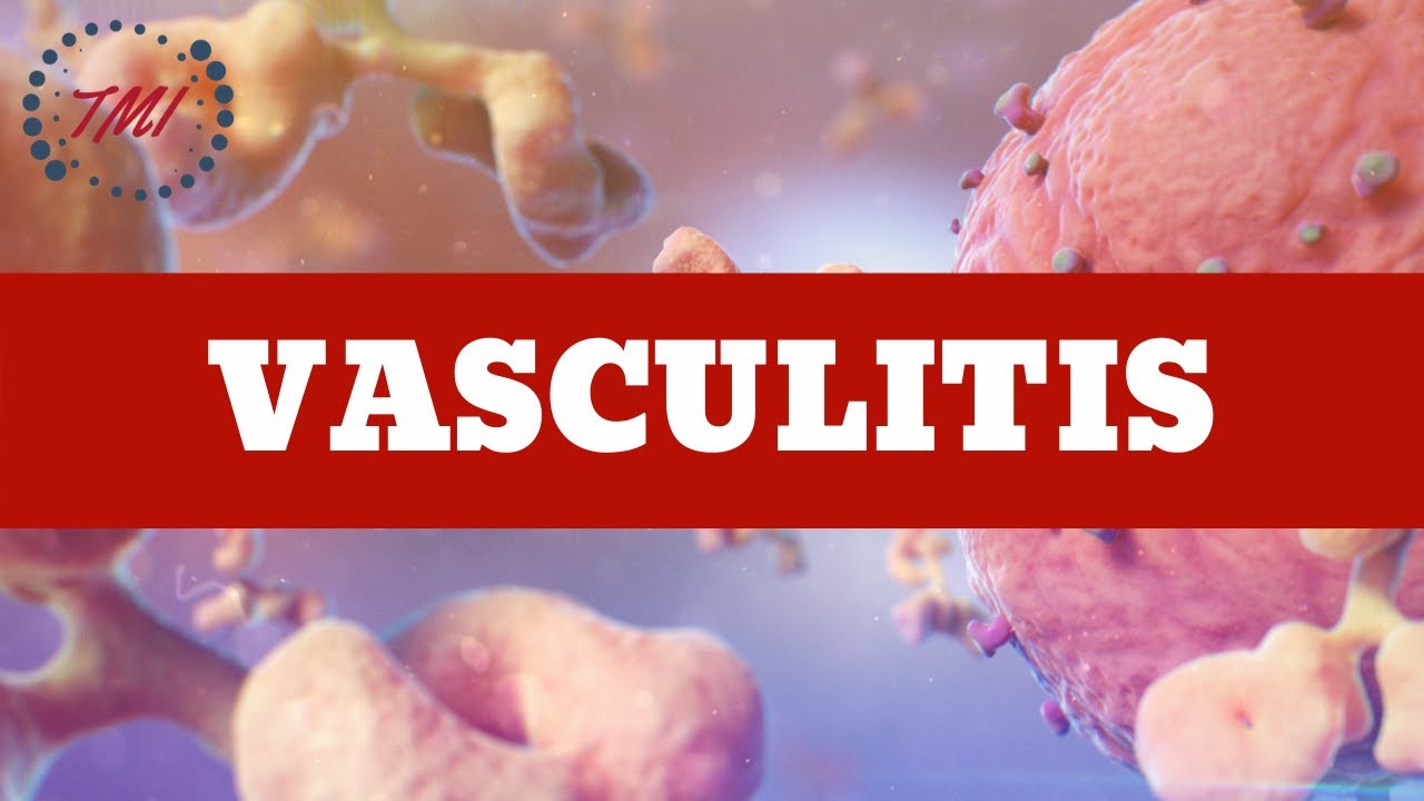 Aproximación a las Vasculitis