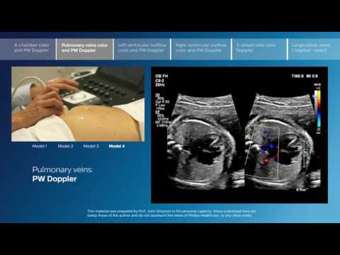 Advanced screening views of the fetal heart - Part 2 - Pulmonary veins color and PW Doppler