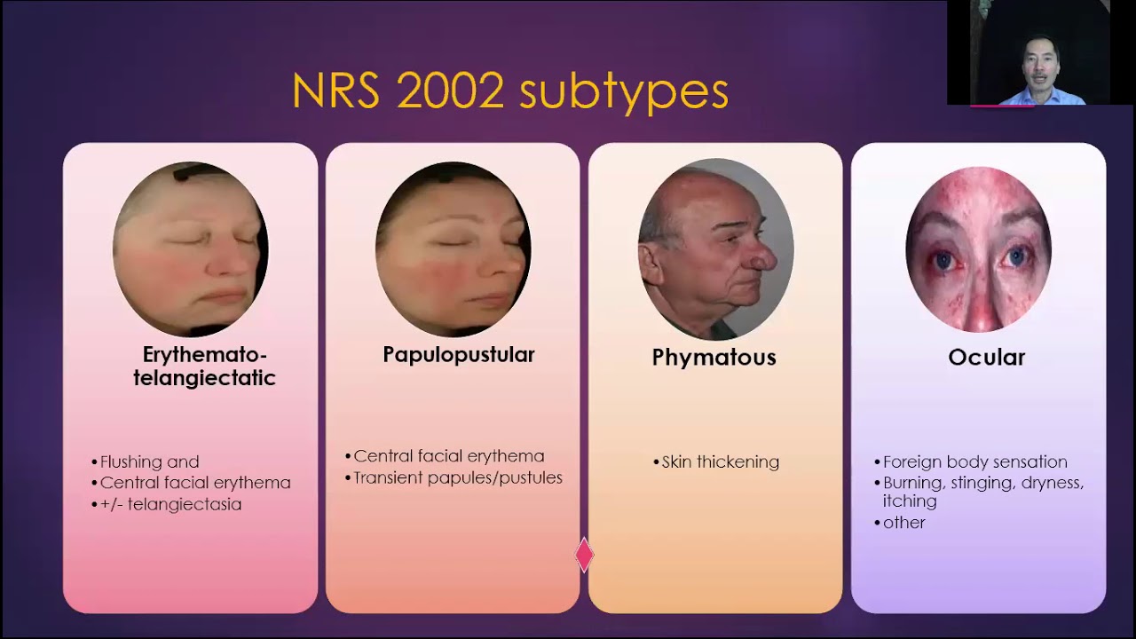 Dr. Jerry Tan - Diagnosis and Management of Rosacea