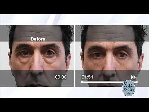 Plexaderm segment 2/28/19 Sac&co