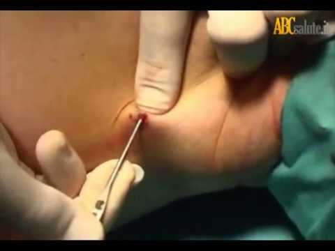 Unguenti trattamento gomito Se un mal di schiena e le gambe sono rifiutati