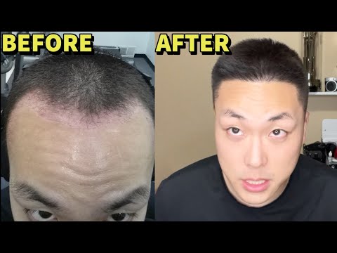 HERE'S WHY YOU SHOULD GET A HAIR TRANSPLANT IN SOUTH...