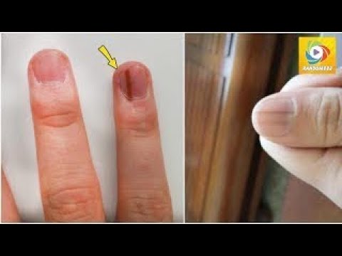 Si vous remarquez une tache noire sur vos ongles, courrez à l’hôpital