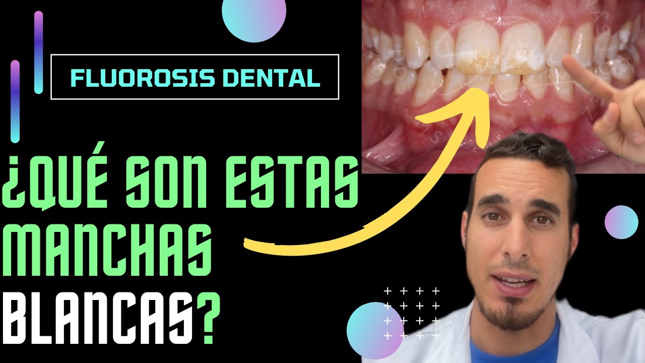 Watch ¿Por qué tiene estas MANCHAS BLANCAS en los DIENTES - FLUOROSIS DENTAL #shorts Now ¿Por qué tiene estas MANCHAS BLANCAS en los DIENTES - FLUOROSIS DENTAL #shorts