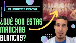¿Por qué tiene estas MANCHAS BLANCAS en los DIENTES - FLUOROSIS DENTAL #shorts