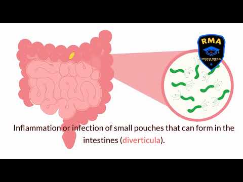 Right Lower Quadrant Pain Differentials  Mnemonic APPENDICITIS with Fraterne ZU@maxkingsphere