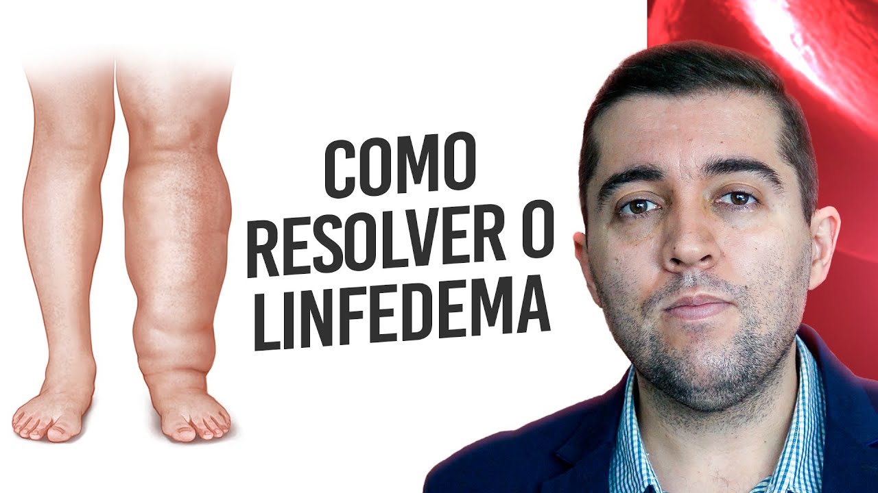 Linfedema: má circulação nos linfáticos que causa inchaço e dor nas pernas. Como resolver?