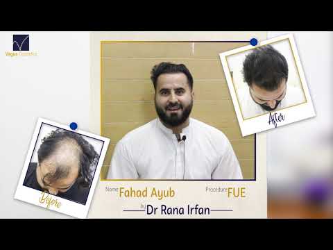 After a successful Hair Transplant surgery ( 9 Month result) Review | Vagus Cosmetics