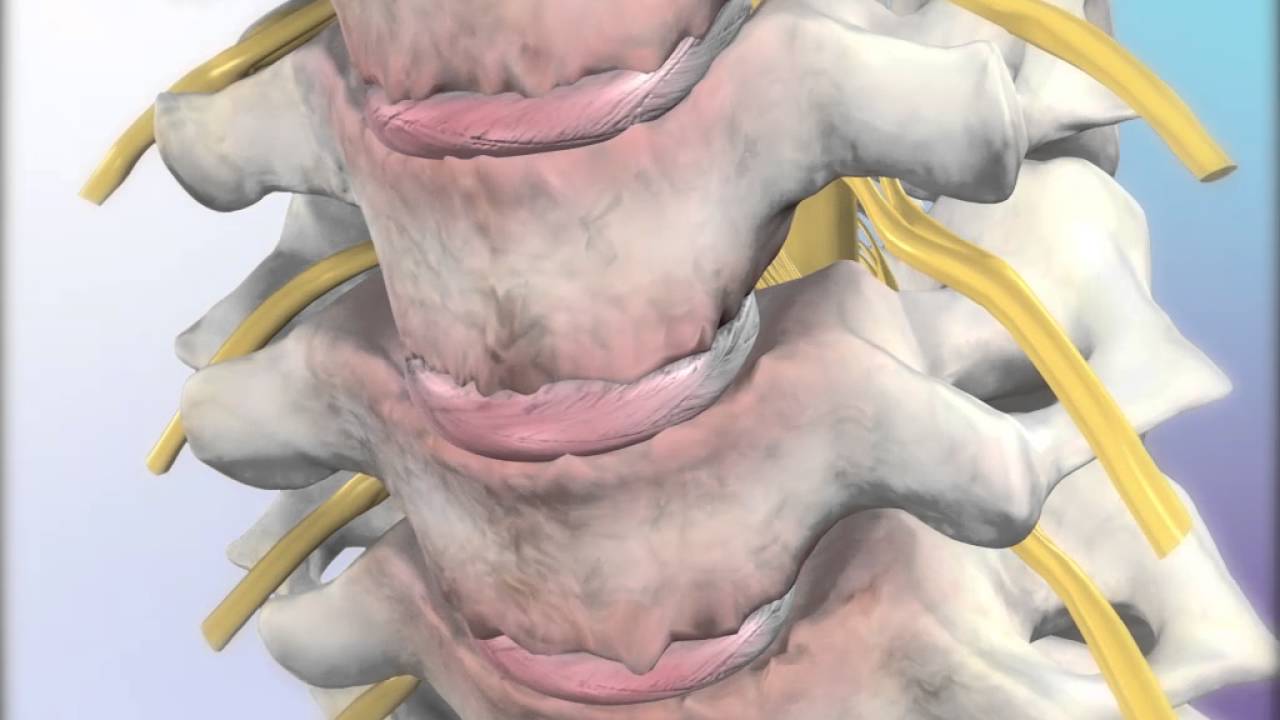 Cervical Spondylosis: Learn@Visible Body