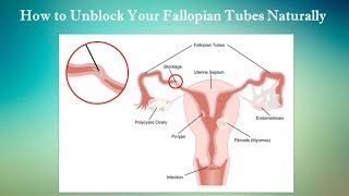How to Unblock Your Fallopian Tubes Naturally