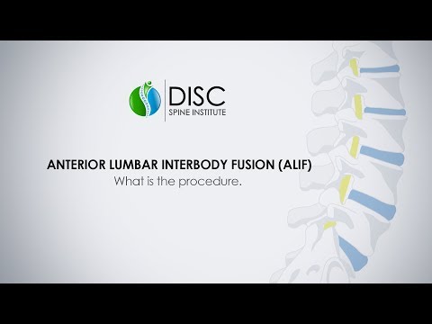 Spine Surgery: Anterior Lumbar Interbody Fusion (ALIF) | DISC Spine Institute Texas