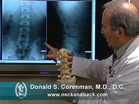 How to Read X-rays of the Lumbar Spine (Lower Back) 