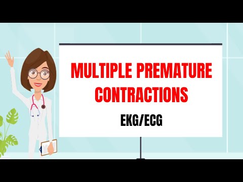 Multiple Premature Beats/ Bigeminy, Trigeminy/ EKG Made Easy