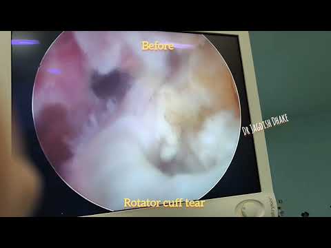 Arthroscopic Rotator Cuff repair by double row repair technique by Dr Jagdish Dhake