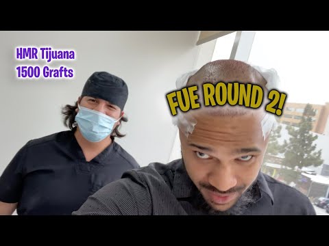 2nd FUE Hair Transplant at HMR in Tijuana Mexico.