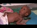 East Africa's tiny children starving to death
