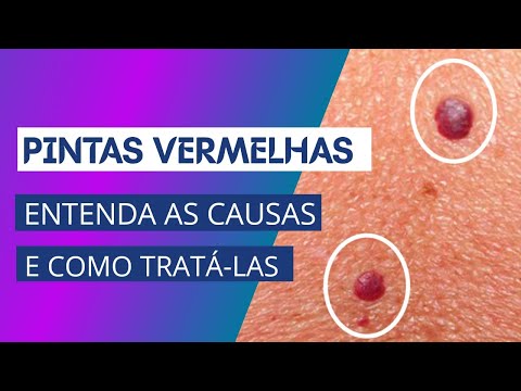 Red Spots - Understand the Causes and How to Treat Them