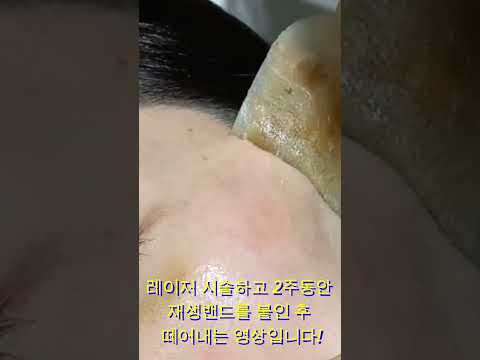 일광흑자 제거 2주 경과 썸네일