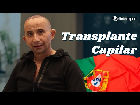 Alfredo Santos de Portugal, Escolheu o Clinicexpert para Transplante Capilar