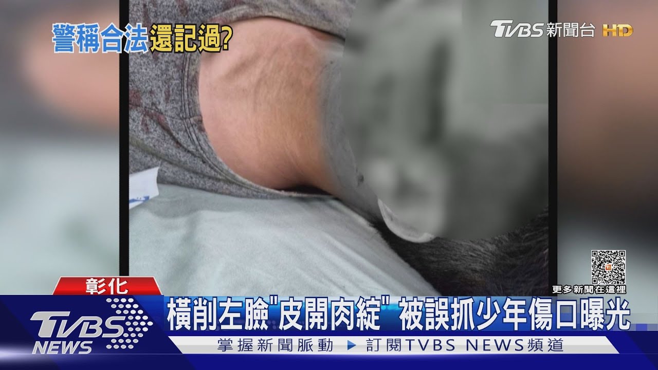 橫削左臉「皮開肉綻」　被誤抓少年傷口曝光