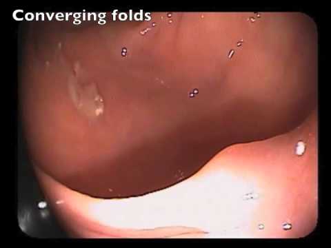 Converging Folds - A Sign of Submucosal Invasion