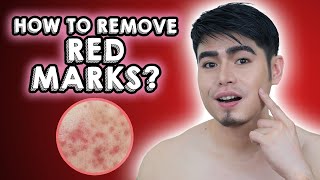 HOW TO REMOVE ACNE RED MARKS? I PIE I Tagalog | Filipino | Raffy Mabunga