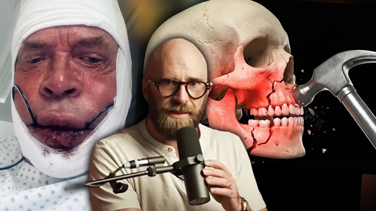 Bonesmashing: The Most Radical “Looksmaxxing” Trend