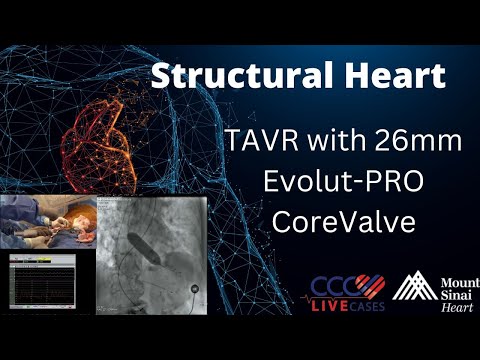 TAVR with 26mm Evolut-PRO CoreValve - May 8, 2018