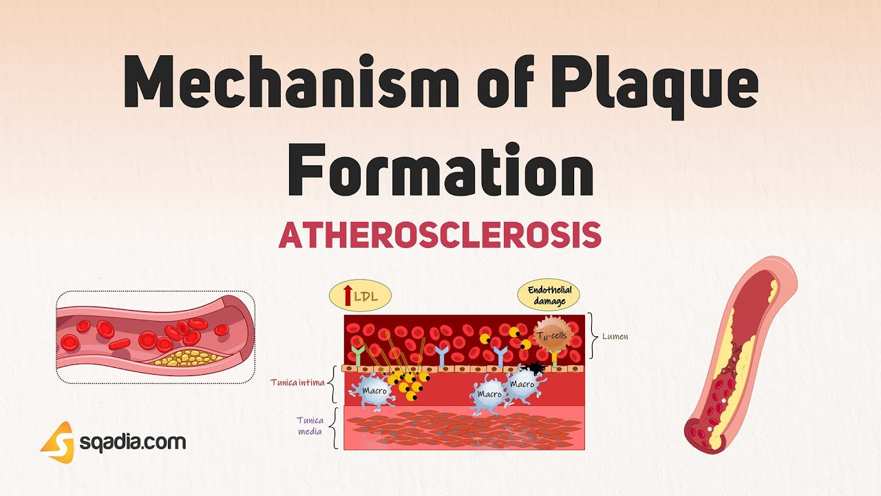 Atherosclerosis | Mechanism of Plaque Formation