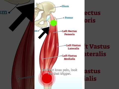 Rectus Femoris Trigger Points
