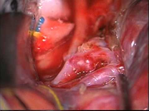 MCA: Αποκλεισμός ραγέντος blister ανευρύσματος διχασμού δεξιάς μέσης εγκεφαλικής αρτηρίας