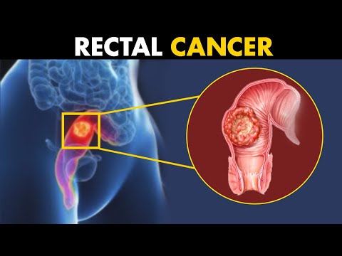 What Happens In Rectal Cancer? | Symptoms, Causes And Treatment