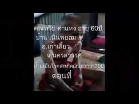 การรักษา Butakova Olga ของโรคสะเก็ดเงิน แชมพูสำหรับโรคสะเก็ดเงิน ICH