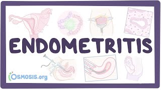 Endometritis - an Osmosis Preview