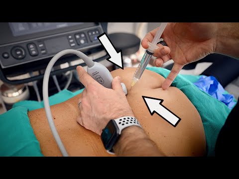 DOCTOR USES ULTRASOUND TO GUIDE HUGE NEEDLES INTO 🔥INFLAMED🔥NERVES (Very Painful) | Dr. Paul