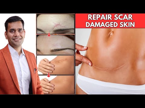 Just 2 Home Remedies Repair Scar & Damaged Skin | Remove Old Scars From Face & Body- Dr.Vivek Joshi