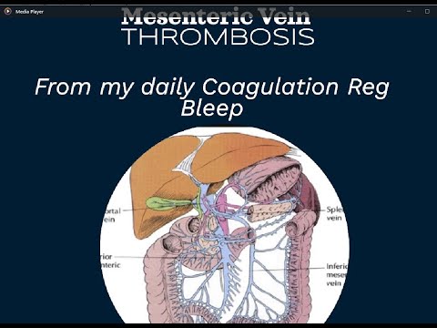 Mesenteric Vein thrombosis