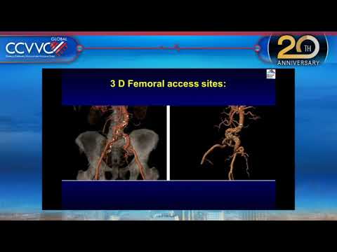 Live Case 12 - CoreValve TAVR for Bioprosthetic Stenosis - CCVVC 2017