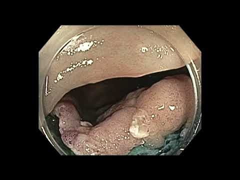 Colonoscopy: Proximal Descending Colon EMR - Detailed Version.