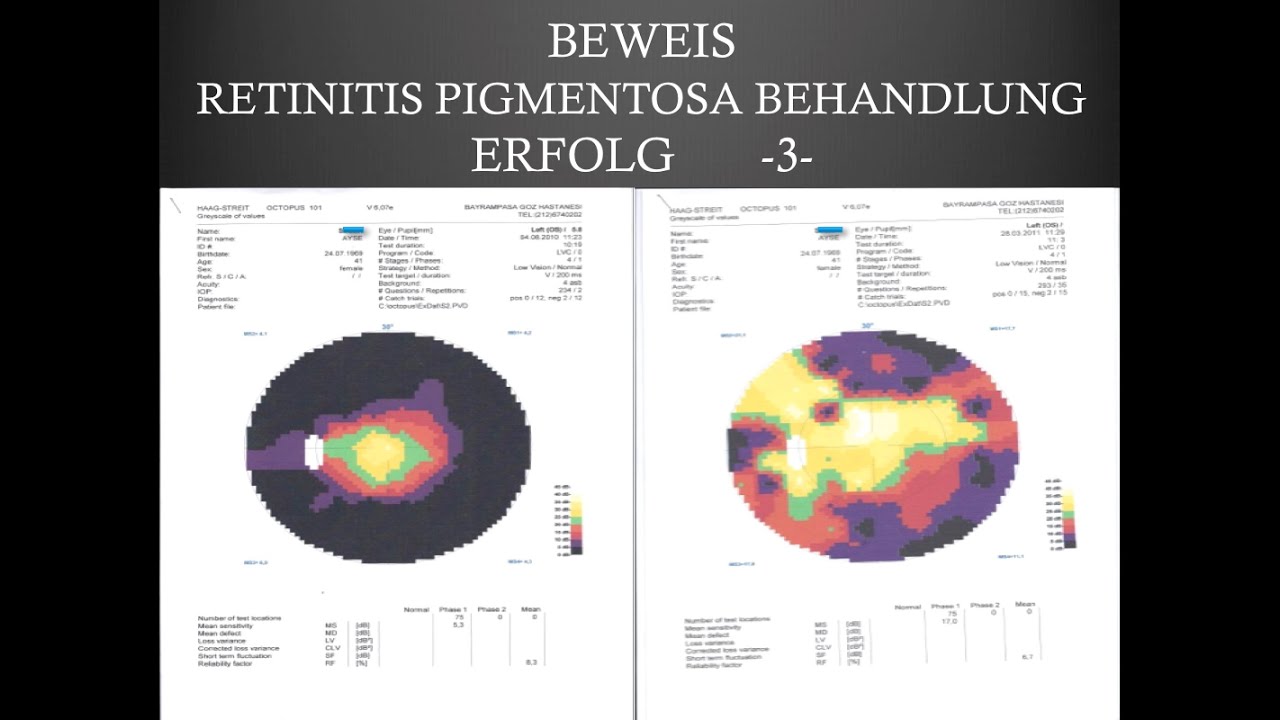 Gesichtsfeldtests 3- Retinitis Pigmentosa Behandlung (Retinopathia Pigmentosa) - FIRATLI KLINIK