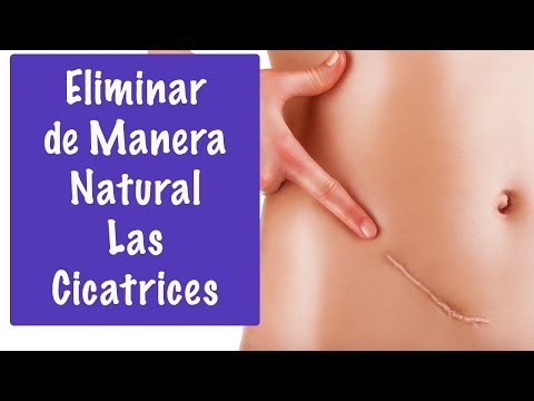 Tratamiento casero y natural para las cicatrices