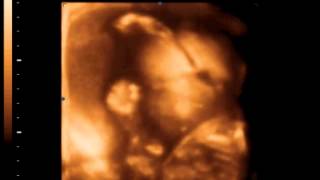 23 haftalık hamilelikte 4 boyutlu ultrason görü